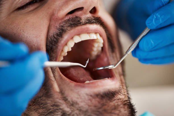 Best Urgent Care for Lost Fillings or Crowns in Pasatiempo, CA