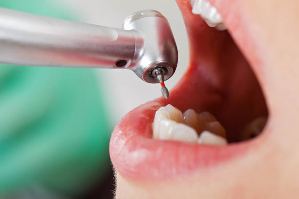 Best Same-Day Emergency Dental Services in Pasatiempo, CA